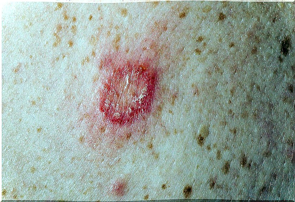 Ringworm is one of the types of fungus on the skin.