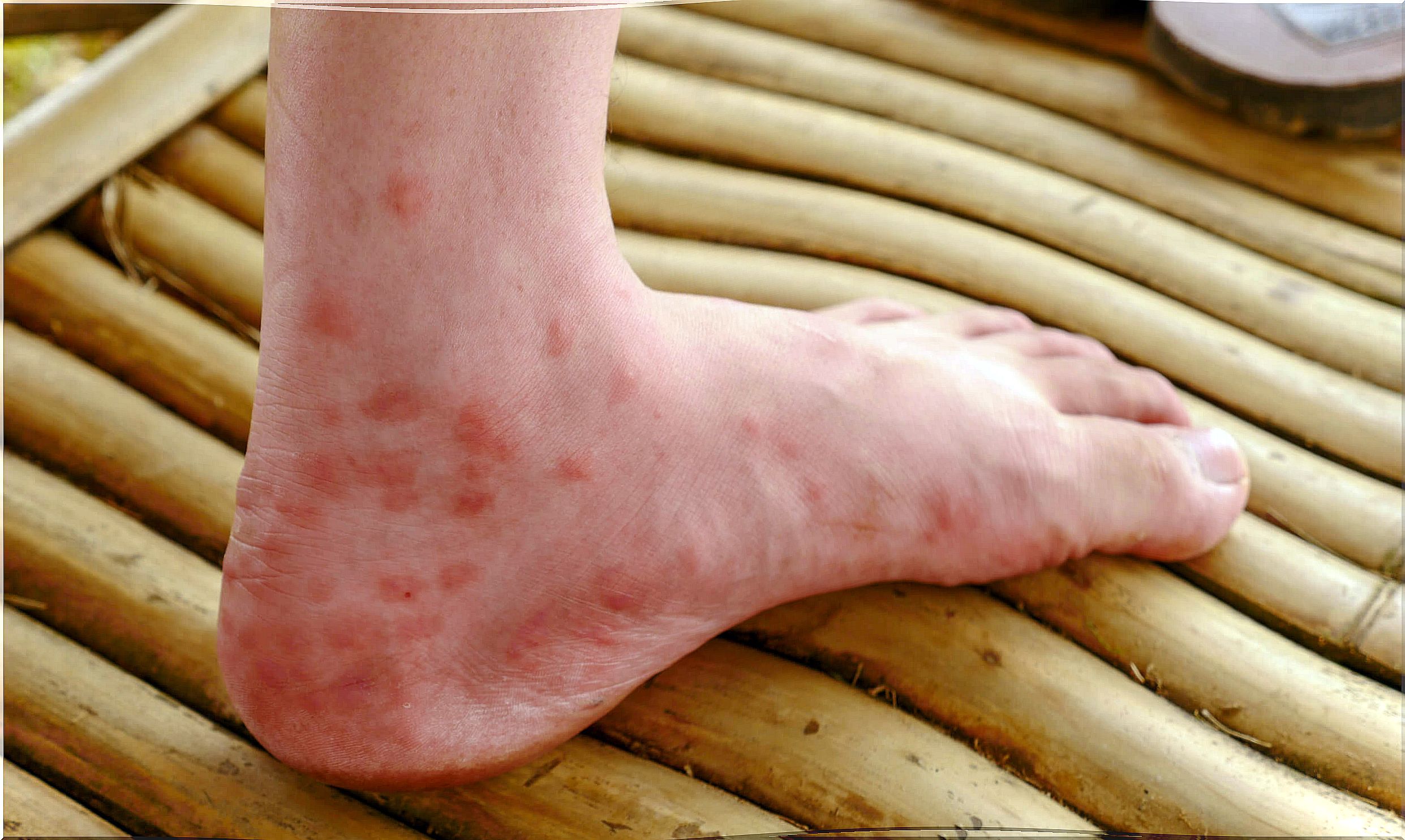 Chronic urticaria comes in several forms.