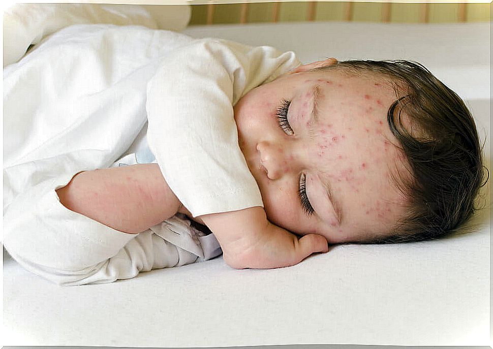 Chickenpox and spring: possible explanations 