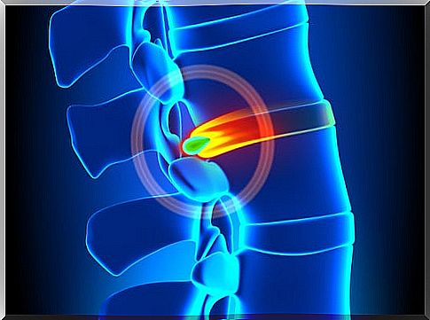 herniated disc