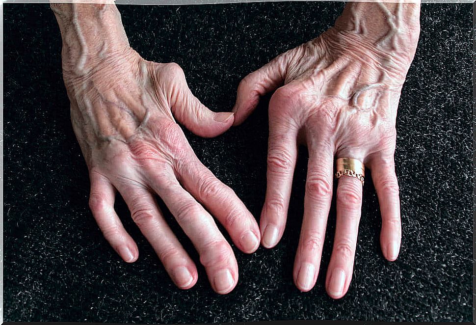 Rheumatoid arthritis hands.