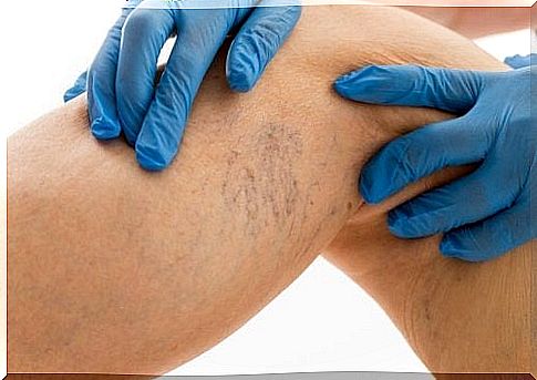 varicose veins