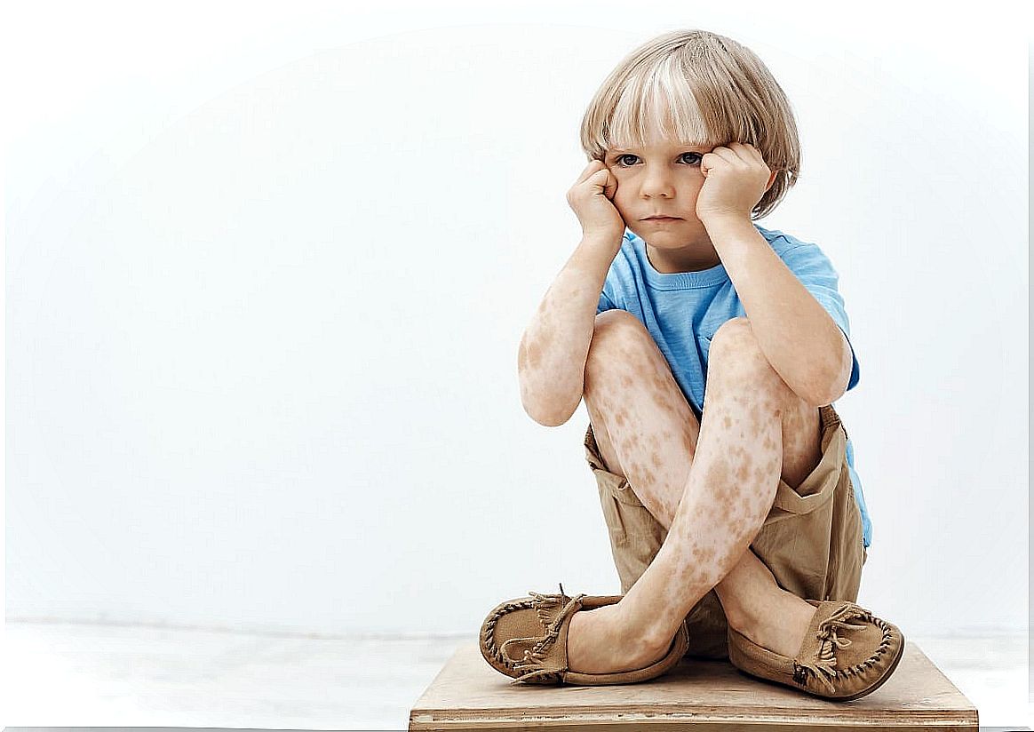 Vitiligo in Children: Tips to Consider