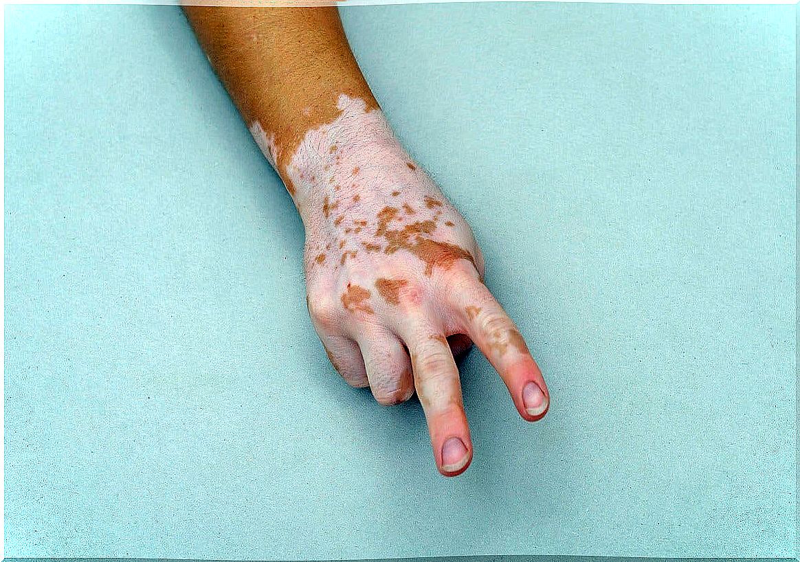 About vitiligo in children