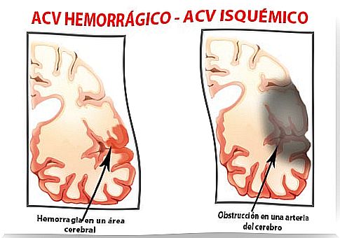 Types of stroke