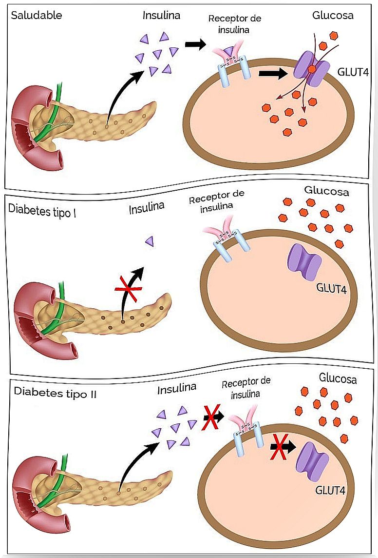 Glucose-diabetes