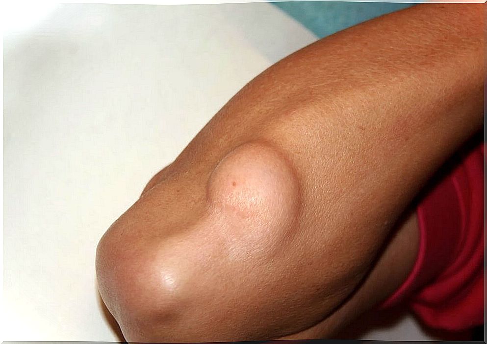 Man with lipoma arm