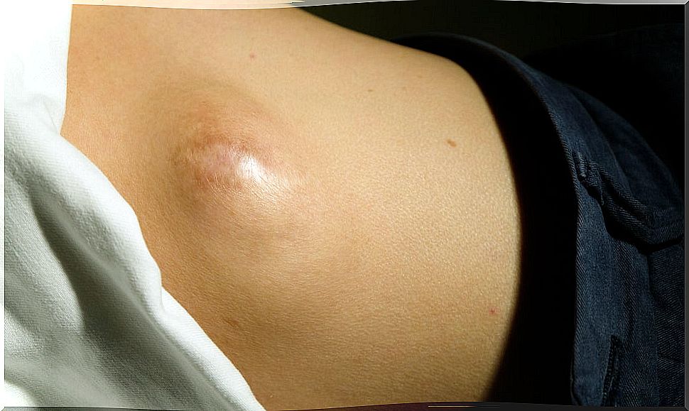 Causes of lipoma of the abdomen  liposarcoma