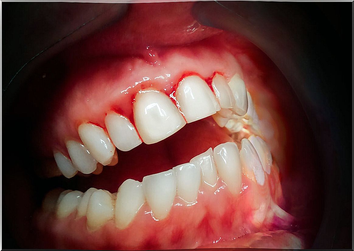 Gingivitis as a complication of dental implants.